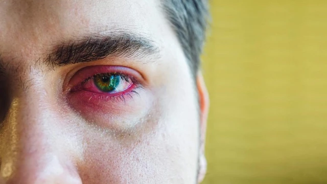 bai-viet/thac-mac-tai-sao-deo-lens-bi-cay-mat-57114.html