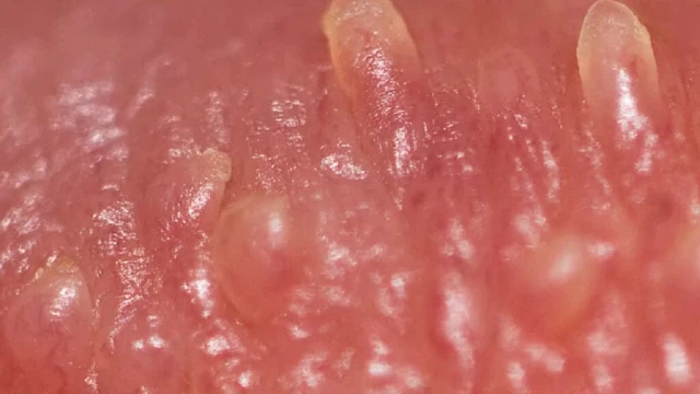 bai-viet/thac-mac-u-nhu-gai-sinh-duc-la-gi-co-nguy-hiem-khong.html