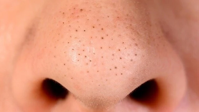 bai-viet/tham-khao-nhung-cach-tri-mun-dau-den-tai-nha-hieu-qua.html