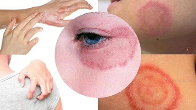 bai-viet/thoi-gian-hac-lao-u-benh-bao-lau-can-luu-y-dieu-gi-55509.html