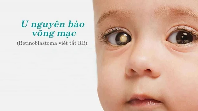 bai-viet/thong-ke-va-nghien-cuu-moi-nhat-ve-benh-u-nguyen-bao-vong-mac-o-tre-em-54517.html