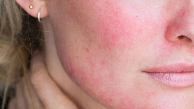 bai-viet/thong-tin-can-biet-ve-viem-mo-te-bao-vung-mat-59392.html