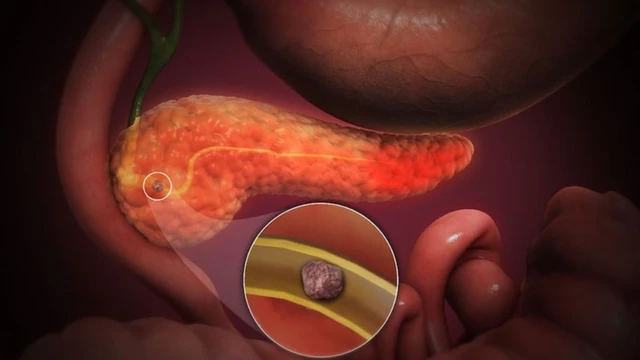 bai-viet/nguyen-nhan-va-phuong-phap-dieu-tri-soi-ong-tuy-ma-ban-co-the-tham-khao.html