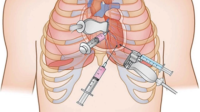 bai-viet/thong-tin-ve-ky-thuat-choc-hut-dich-mang-tim.html