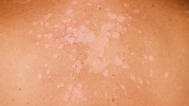 bai-viet/thuoc-boi-dieu-tri-lang-ben-dien-rong-53589.html