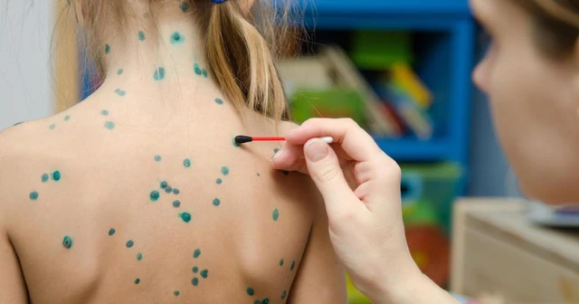 bai-viet/dung-thuoc-thuy-dau-boi-xanh-methylen-de-mau-lanh-benh-40543.html