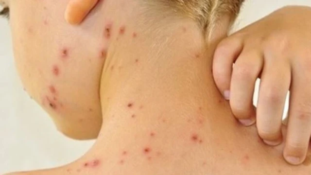 bai-viet/thuoc-dac-tri-ghe-ngua-o-tre-em-giai-phap-hieu-qua-cho-van-de-da-di-ung.html