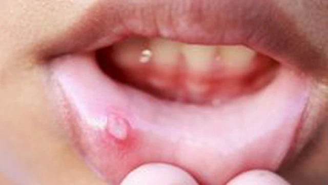 bai-viet/thuoc-oracortia-co-dung-duoc-cho-tre-em-khong-va-nen-dung-thuoc-an-toan-cho-tre-the-nao.html