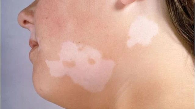 bai-viet/thuoc-tri-lang-ben-nau-an-toan-hieu-qua-53450.html