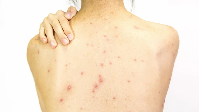 bai-viet/mot-so-thuoc-tri-mun-lung-o-tiem-thuoc-tay.html