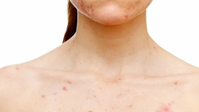 bai-viet/thuoc-tri-nam-nizoral-cream-tri-mun-duoc-khong-cac-luu-y-khi-dieu-tri-mun-ma-ban-nen-biet.html