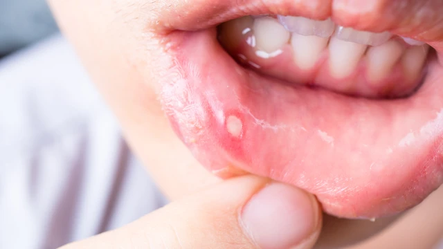 bai-viet/thuong-xuyen-bi-nhiet-mieng-la-do-dau.html