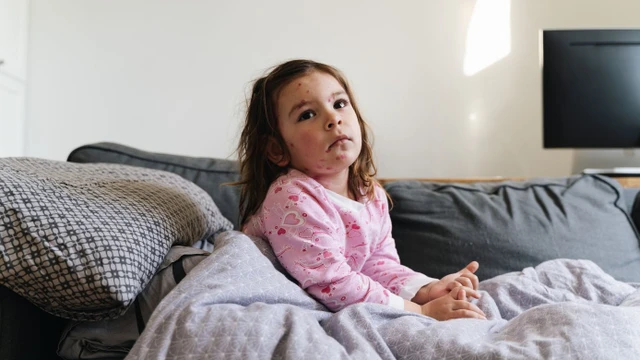 bai-viet/mun-thuy-dau-noi-nhieu-o-mat-nguyen-nhan-bien-chung-va-cach-xu-ly-hieu-qua.html