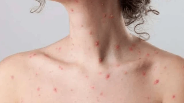 bai-viet/thuy-dau-o-nguoi-lon-co-nguy-hiem-khong-cach-dieu-tri-va-phong-ngua-bien-chung.html