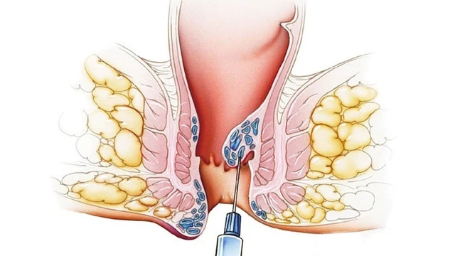 bai-viet/tiem-xo-bui-tri-khong-can-phau-thuat.html