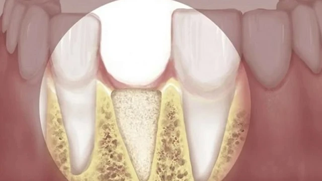 bai-viet/tieu-xuong-rang-nguy-hiem-nhu-the-nao-den-suc-khoe-72962.html