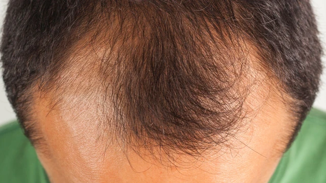 bai-viet/cay-toc-chu-m-giai-phap-cho-nhung-ai-bi-hoi-vung-tran.html