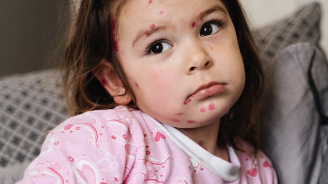 bai-viet/tim-hieu-cac-trieu-chung-thuy-dau-khi-moi-khoi-phat-va-bien-phap-phong-ngua-benh.html