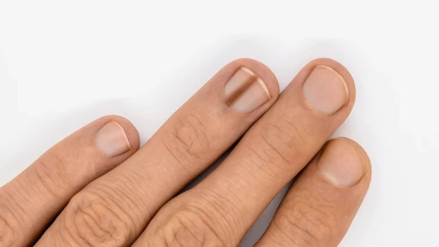 bai-viet/tim-hieu-mong-tay-co-soc-den-nho-la-benh-gi.html