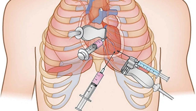 bai-viet/khi-nao-can-dan-luu-dich-mang-ngoai-tim.html