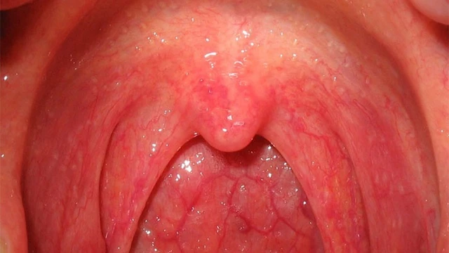 bai-viet/tim-hieu-ve-benh-ung-thu-vom-hong-va-viem-vom-hong.html