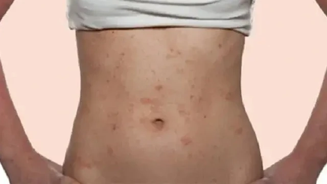 bai-viet/noi-mun-o-bung-tim-hieu-ve-nguyen-nhan-cach-dieu-tri-va-phong-ngua.html