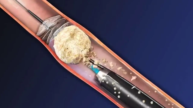 bai-viet/tim-hieu-ve-tan-soi-than-qua-da-phuong-phap-dieu-tri-soi-than.html