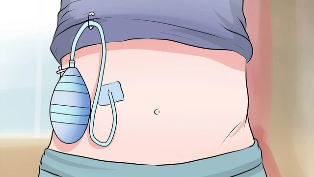 bai-viet/dan-luu-o-bung-la-gi-quy-trinh-thuc-hien-thu-thuat-dan-luu-o-bung.html