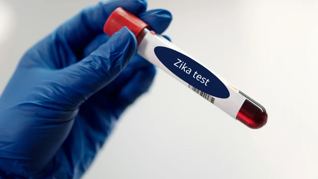bai-viet/tim-hieu-xet-nghiem-virus-zika-va-quy-trinh-thuc-hien.html