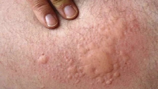 bai-viet/noi-me-day-o-mong-gay-ngua-kho-chiu-phai-lam-sao-54410.html