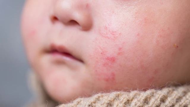 bai-viet/tinh-trang-rom-say-o-tre-em-va-nhung-thong-tin-cha-me-can-biet.html