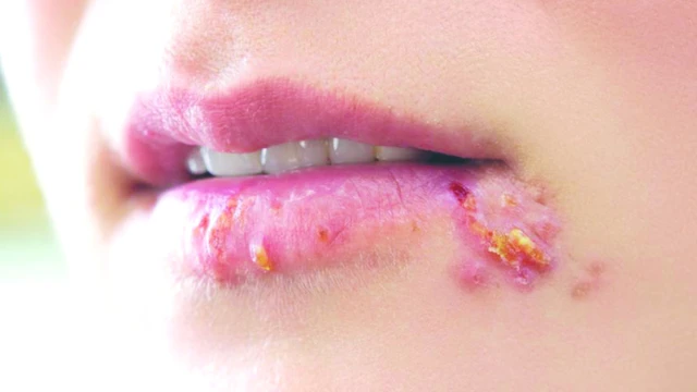 bai-viet/to-dia-o-moi-nguyen-nhan-cach-nhan-biet-va-dieu-tri-56825.html