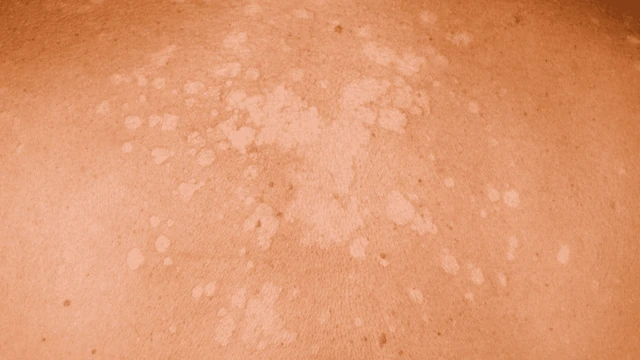 bai-viet/tong-hop-5-benh-nam-da-thuong-gap-va-cach-phong-ngua.html