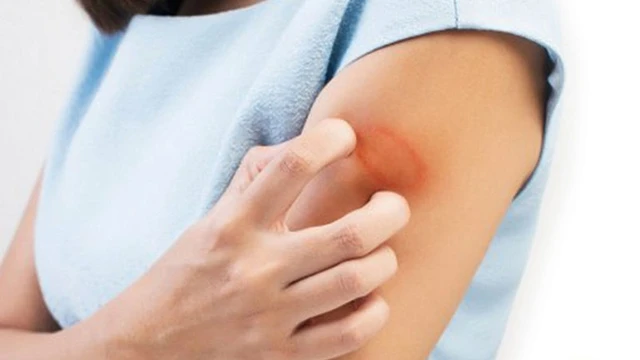 bai-viet/tong-hop-nhung-cach-chua-tri-cham-soc-khi-bi-hac-lao-nang-55253.html