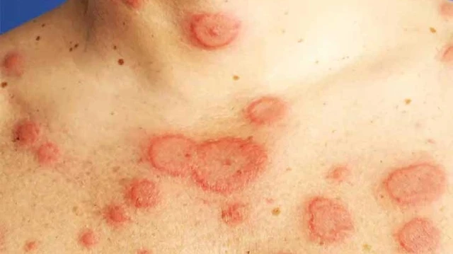 bai-viet/tong-quan-ve-benh-lupus-ban-do-dang-dia-55744.html