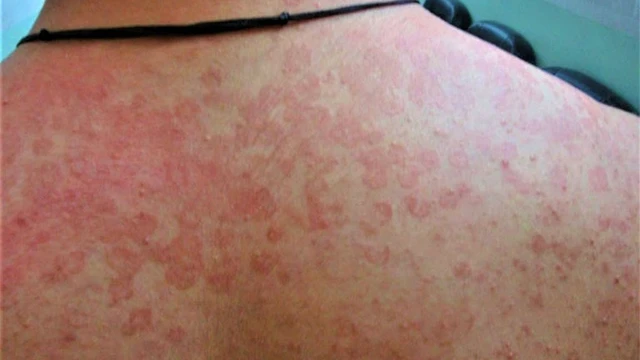 bai-viet/mot-so-hinh-anh-benh-lang-ben-do-thuong-gap-53036.html