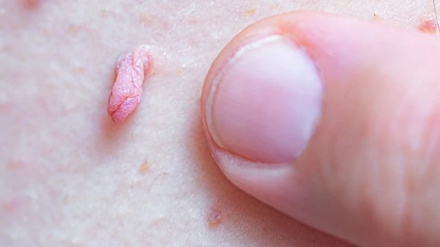 bai-viet/tong-quan-ve-sui-mao-ga-giai-doan-cuoi-trieu-chung-nguy-hai-va-cach-dieu-tri.html