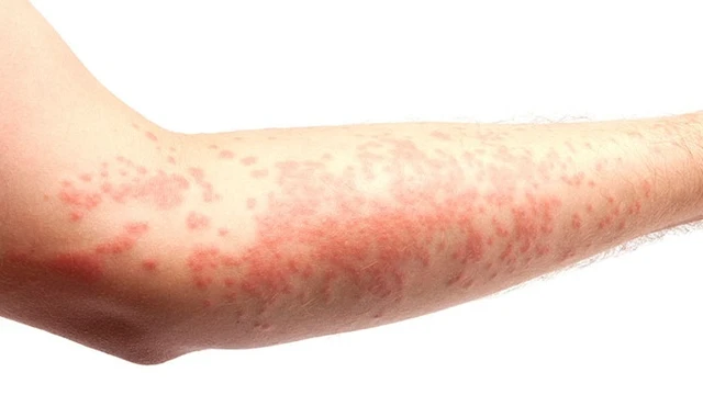 bai-viet/top-4-loai-thuoc-chua-me-day-man-tinh-hieu-qua-54768.html