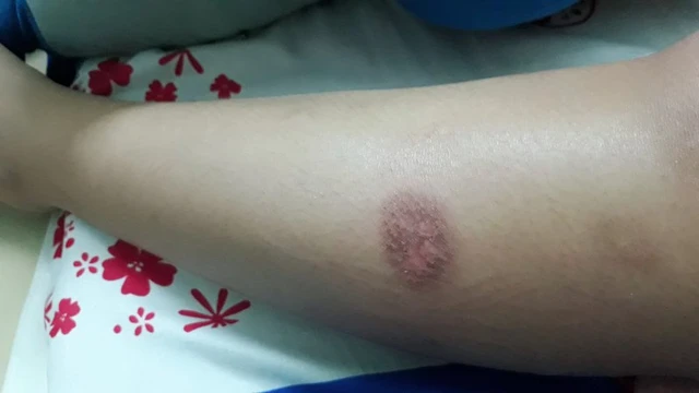 bai-viet/top-6-kem-tri-seo-bong-cho-be-tot-nhat-60643.html