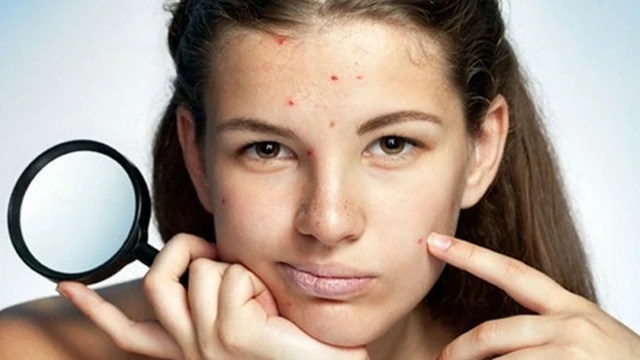 bai-viet/top-6-thuoc-uong-tri-mun-noi-tiet-tot-nhat-hien-nay-53825.html