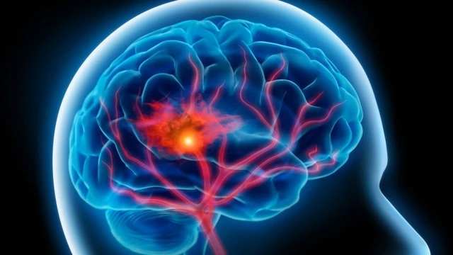 bai-viet/tpa-la-gi-tam-quan-trong-cua-tpa-trong-dieu-tri-dot-quy.html