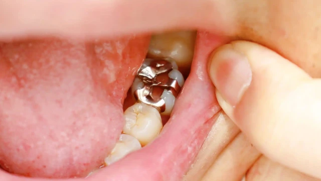 bai-viet/khi-nao-can-tram-lai-rang-da-tram-va-luu-y-khi-thuc-hien.html