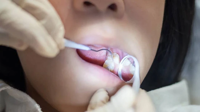 bai-viet/tram-rang-sau-lo-to-bao-nhieu-tien-cac-yeu-to-anh-huong-den-chi-phi.html