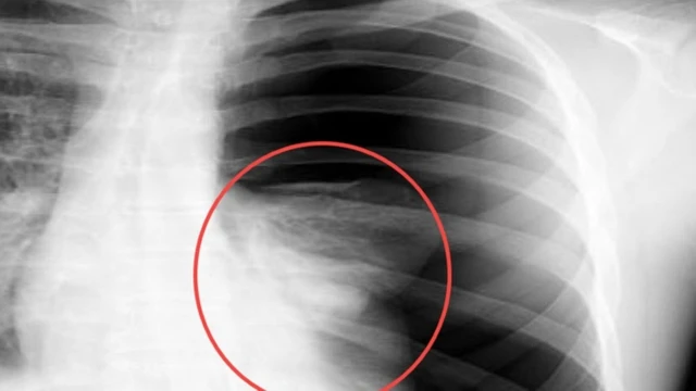 bai-viet/tran-dich-mang-phoi-co-nguy-hiem-khong-cach-xu-ly-nhu-the-nao.html