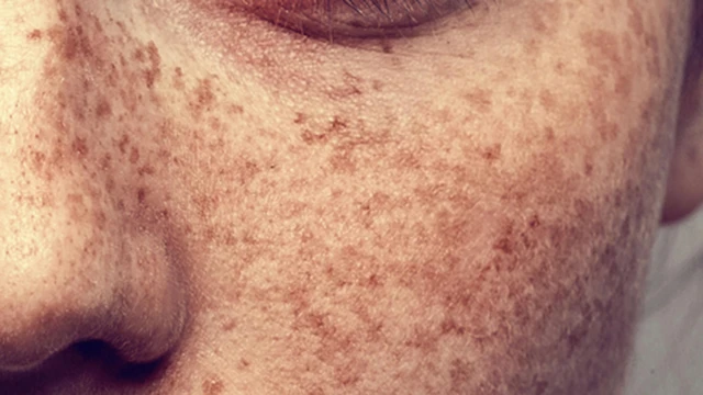 bai-viet/tranh-nang-de-giam-bi-doi-moi-sau-nay-52518.html