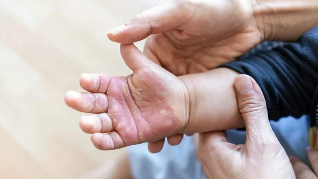 bai-viet/tre-bi-bong-boi-thuoc-gi-nen-lam-gi-khi-tre-bi-bong.html