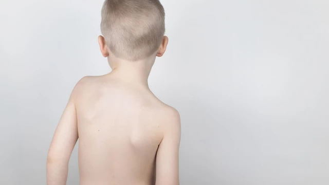 bai-viet/tre-bi-coi-xuong-nen-bo-sung-gi-cach-bo-sung-che-do-an-cho-tre-bi-coi-xuong.html