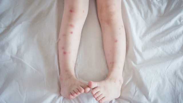 bai-viet/tre-bi-noi-man-do-o-chan-la-benh-gi-cach-dieu-tri-ra-sao.html