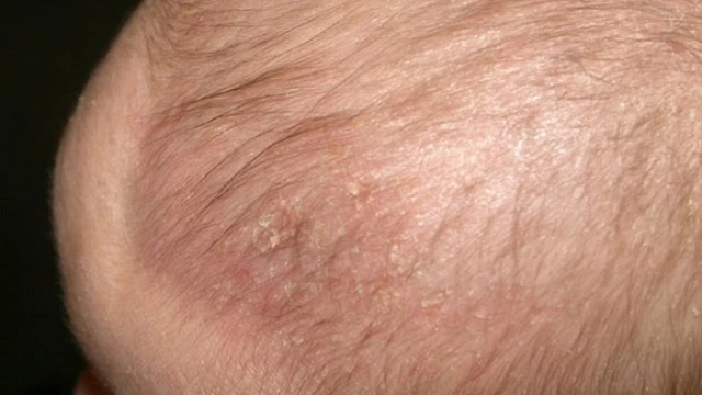 bai-viet/tre-bi-noi-mun-mu-tren-dau-la-do-dau-can-xu-ly-nhu-the-nao.html