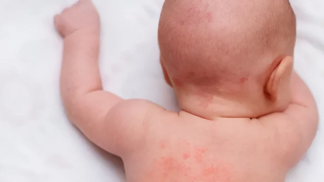 bai-viet/tre-bi-rom-say-nen-tam-la-gi-nhanh-het-man-do-ngua-ngay-58557.html